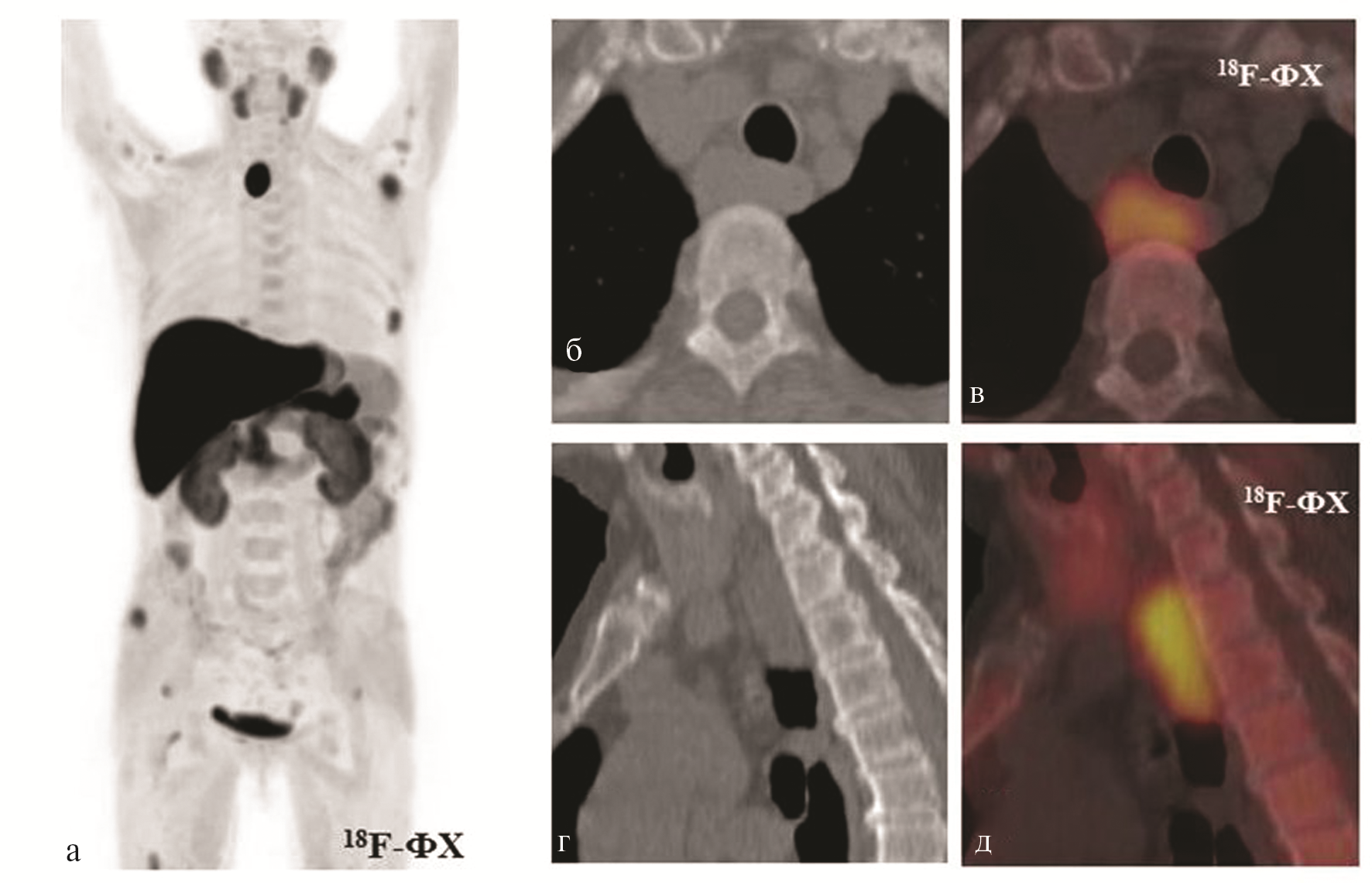 ПЭТ кт лимфома Ходжкина. ПЭТ-кт с 18f-фтордезоксиглюкозой. Позитронно-эмиссионная томография метастазы.