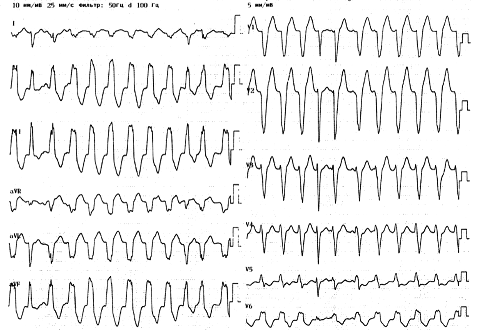 Желудочковая тахикардия на экг. Мономорфная желудочковая тахикардия ЭКГ. Инфаркт миокарда и желудочковая тахикардия ЭКГ. Желудочков я тахикардия на ЭКГ.